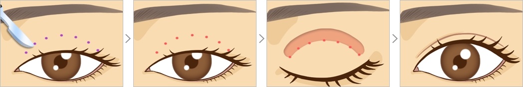 맑은누리 눈매교정 수술 방법 삽화