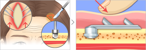 맑은누리 상안검 성형술 수술 방법 삽화