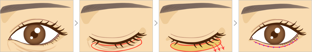 맑은누리 하안검 성형술 방법 삽화
