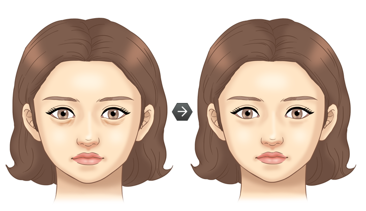 하안검 성형술(지방재배치) 전후모습 삽화