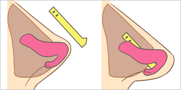 비중격 또는 갈비뼈 연골 연장술 삽화