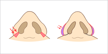 콧망울의 피부를 제거하는 방법 삽화