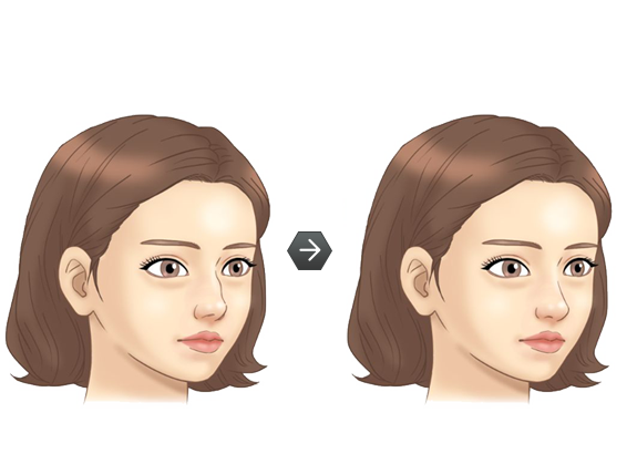 코 재수술 전후모습 삽화