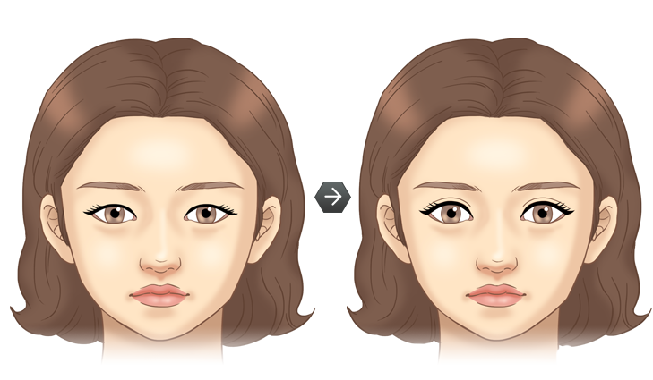 매몰법 전후모습 삽화