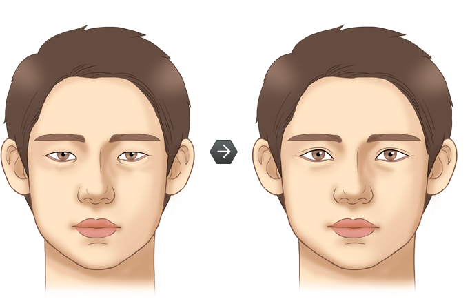 남성쌍꺼풀 전후모습 삽화