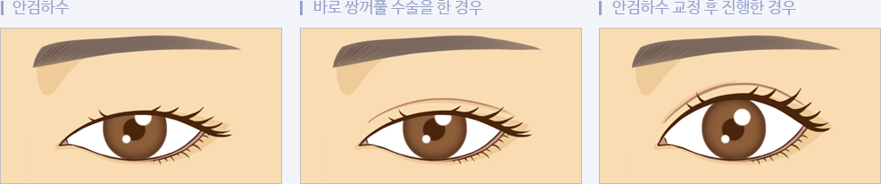 안검하수 교정이 필요한 이유 삽화