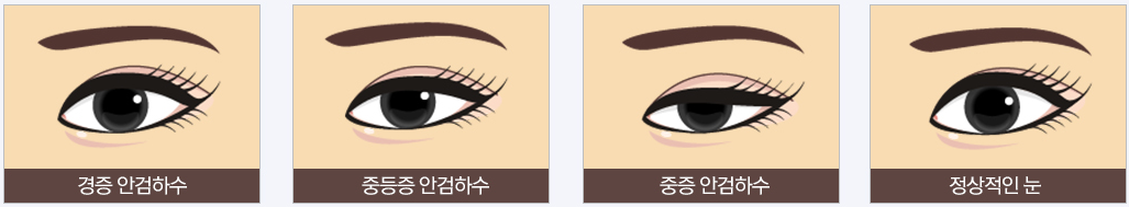 안검하수의 정도