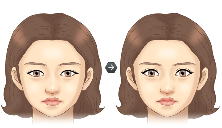 눈매교정 전후모습 삽화