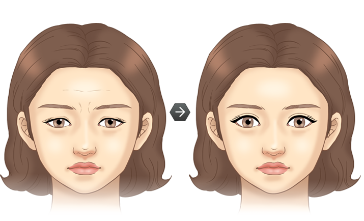 눈썹하거상술 전후모습 삽화