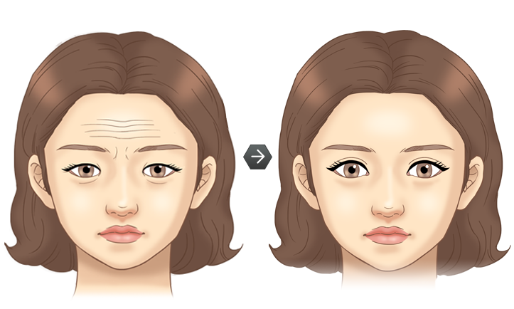 눈썹하거상술 전후모습 삽화