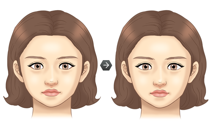 눈썹하거상술 전후모습 삽화