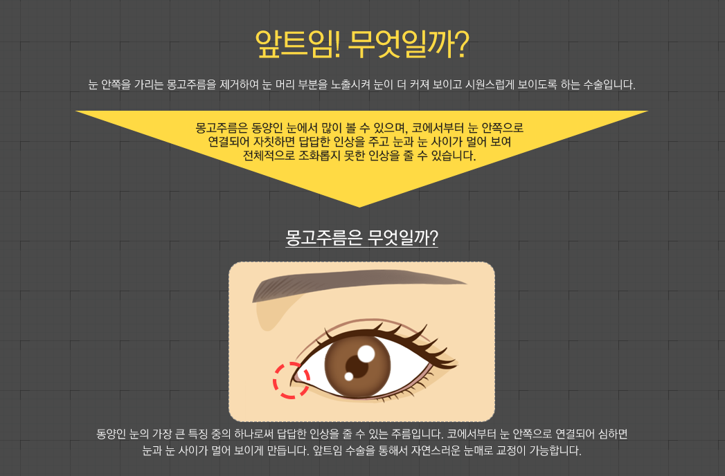앞트임! 무엇일까? 눈 안쪽을 가리는 몽고주름을 제거하여 눈 머리 부분을 노출시켜 눈이 더 커져 보이고 시원스럽게 보이도록 하는 수술입니다. 몽고주름은 동양인 눈에서 많이 볼 수 있으며, 코에서부터 눈 안쪽으로 연결되어 자칫하면 답답한 인상을 주고 눈과 눈 사이가 멀어 보여 전체적으로 조화롭지 못한 인상을 줄 수 있습니다. 몽고주름은 무엇일까? : 동양인 눈의 가장 큰 특징 중의 하나로써 답답한 인상을 줄 수 있는 주름입니다. 코에서부터 눈 안쪽으로 연결되어 심하면 눈과 눈 사이가 멀어 보이게 만듭니다. 앞트임 수술을 통해서 자연스러운 눈매로 교정이 가능합니다.