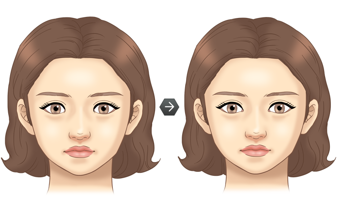 앞트임 전후모습 삽화
