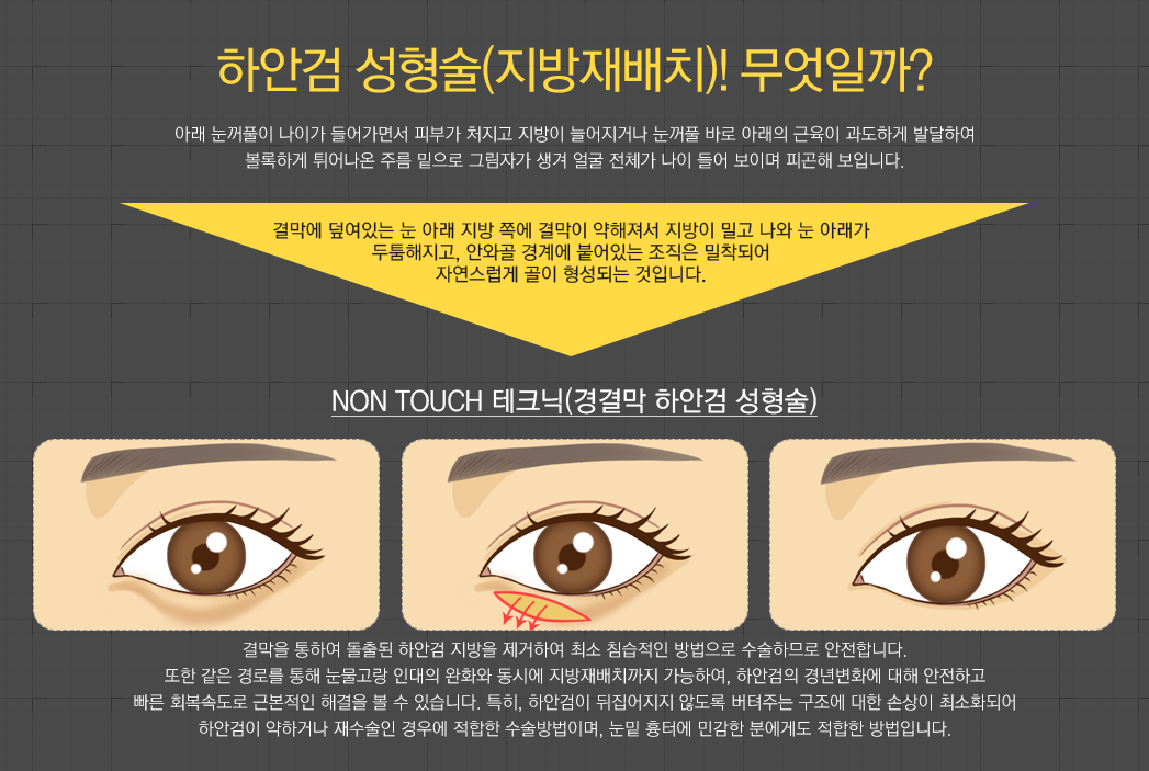 하안검 성형술(지방재배치)! 무엇일까? 아래 눈꺼풀이 나이가 들어가면서 피부가 처지고 지방이 늘어지거나 눈꺼풀 바로 아래의 근육이 과도하게 발달하여 볼록하게 튀어나온 주름 밑으로 그림자가 생겨 얼굴 전체가 나이 들어 보이며 피곤해 보입니다. 결막에 덮여있는 눈 아래 지방 쪽에 결막이 약해져서 지방이 밀고 나와 눈 아래가 두툼해지고, 안와골 경계에 붙어있는 조직은 밀착되어 자연스럽게 골이 형성되는 것입니다. Non Touch 테크닉(경결막 하안검 성형술) 결막을 통하여 돌출된 하안검 지방을 제거하여 최소 침습적인 방법으로 수술하므로 안전합니다. 또한 같은 경로를 통해 눈물고랑 인대의 완화와 동시에 지방재배치까지 가능하여, 하안검의 경년변화에 대해 안전하고 빠른 회복속도로 근본적인 해결을 볼 수 있습니다. 특히, 하안검이 뒤집어지지 않도록 버텨주는 구조에 대한 손상이 최소화되어 하안검이 약하거나 재수술인 경우에 적합한 수술방법이며, 눈밑 흉터에 민감한 분에게도 적합한 방법입니다.