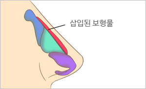 콧등이 튀어나온 정도가 가벼운 경우 삽화