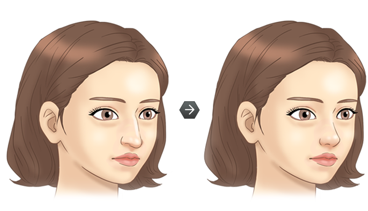 매부리코성형 전후모습 삽화