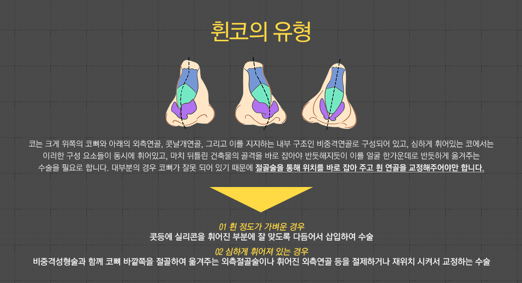 휜코의 유형 코는 크게 위쪽의 코뼈와 아래의 외측연골, 콧날개연골, 그리고 이를 지지하는 내부 구조인 비중격연골로 구성되어 있고, 심하게 휘어있는 코에서는 이러한 구성 요소들이 동시에 휘어있고, 마치 뒤틀린 건축물의 골격을 바로 잡아야 반듯해지듯이 이를 얼굴 한가운데로 반듯하게 옮겨주는 수술을 필요로 합니다. 대부분의 경우 코뼈가 잘못 되어 있기 때문에 절골술을 통해 위치를 바로 잡아 주고 휜 연골을 교정해주어야만 합니다. - 01 휜 정도가 가벼운 경우:콧등에 실리콘을 휘어진 부분에 잘 맞도록 다듬어서 삽입하여 수술, 02 심하게 휘어져 있는 경우:비중격성형술과 함께 코뼈 바깥쪽을 절골하여 옮겨주는 외측절골술이나 휘어진 외측연골 등을 절제하거나 재위치 시켜서 교정하는 수술