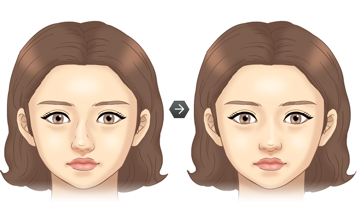 휜코성형 전후모습 삽화