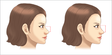 콧대성형술 삽화