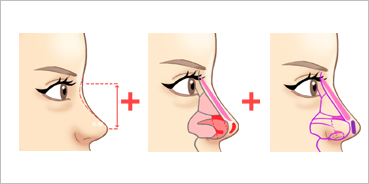콧대성형술 + 코끝 연장술 + 연골성형술 삽화
