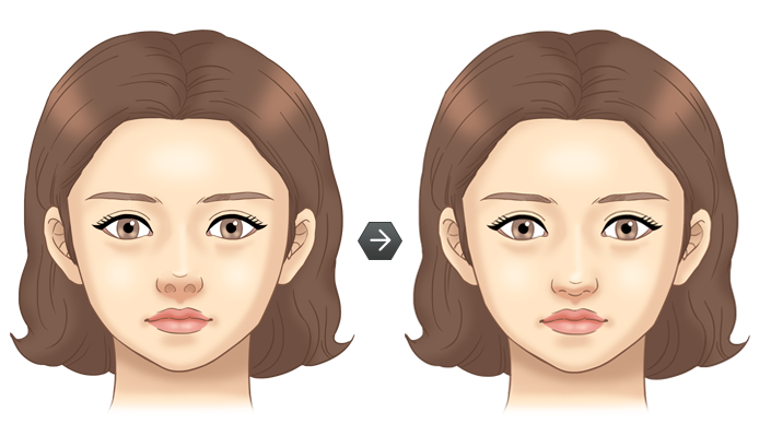 휜코성형 전후모습 삽화