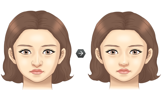 화살코성형 전후모습 삽화