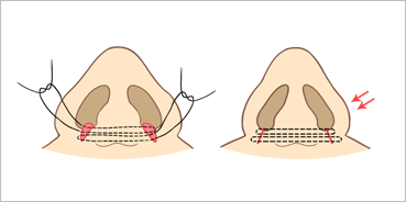 콧망울을 모아주는 방법 삽화