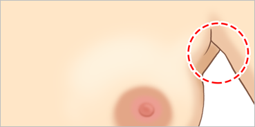 겨드랑이 절개법 삽화