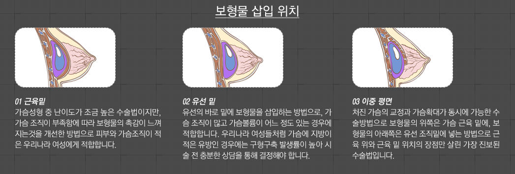 보형물 삽입 위치 - 01 근육밑:가슴성형중난이도가조금높은수술법이지만,가슴조직이부족함에따라보형물의촉감이느껴지는것을개선한방법으로피부와가슴조직이적은우리나라여성에게적합합니다. 02 유선 밑:유선의바로밑에보형물을삽입하는방법으로,가슴조직이많고가슴볼륨이어느정도있는경우에적합합니다.우리나라여성들처럼가슴에지방이적은유방인경우에는구형구축발생률이높아시술전충분한상담을통해결정해야합니다. 03 이중 평면:처진가슴의교정과가슴확대가동시에가능한수술방법으로보형물의위쪽은가슴근육밑에,보형물의아래쪽은유선조직밑에넣는방법으로근육위와근육밑위치의장점만살린가장진보된수술법입니다.