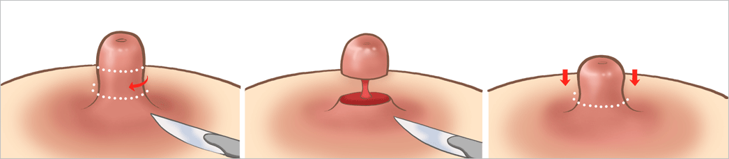 유관 보존법 (수유를 가능하게 하는 방법) 삽화