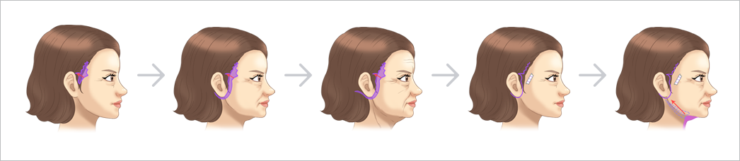 안면거상술 삽화