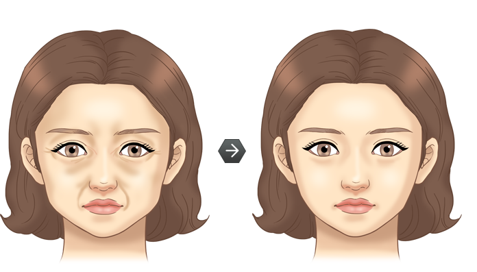 주름성형 전후모습 삽화