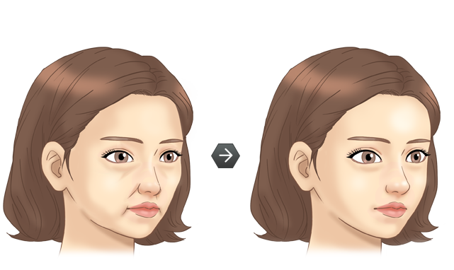 지방이식 전후모습 삽화