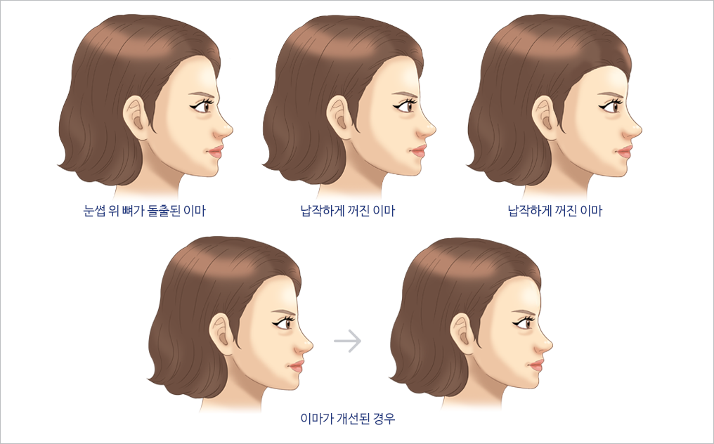 이마성형 삽화