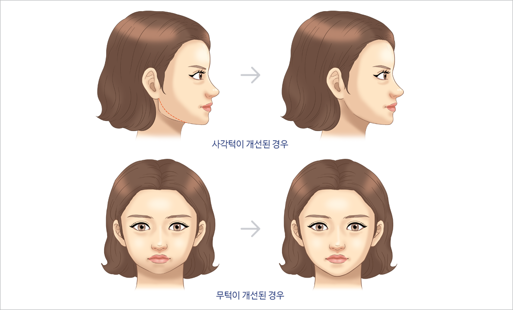턱 삽화