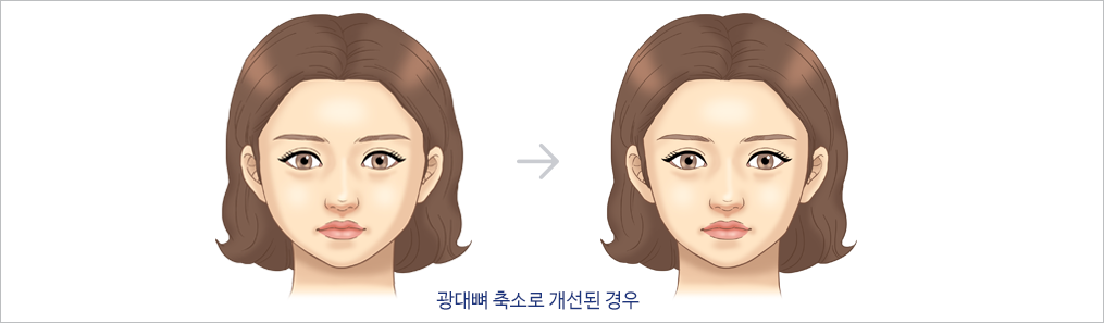 광대뼈 삽화