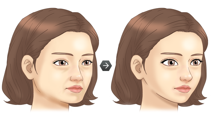 주름성형 전후모습 삽화