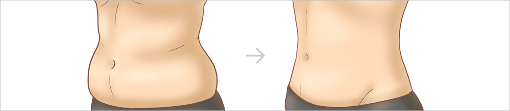 복부지방흡입 삽화