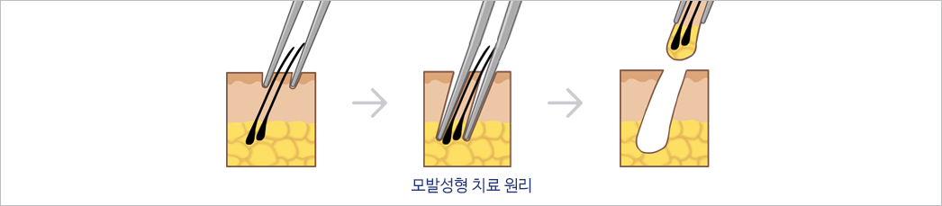 모발성형 치료 삽화