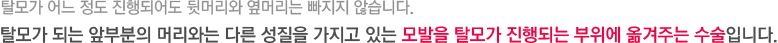 탈모가 어느 정도 진행되어도 뒷머리와 옆머리는 빠지지 않습니다. 탈모가 되는 앞부분의 머리와는 다른 성질을 가지고 있는 모발을 탈모가 진행되는 부위에 옮겨주는 수술입니다.