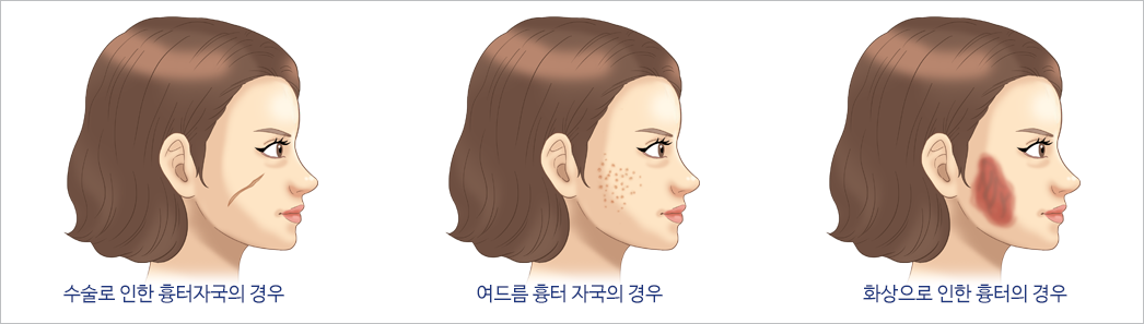 수술로 인한 흉터자국의 경우, 여드름 흉터 자국의 경우, 화상으로 인한 흉터의 경우