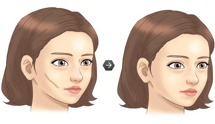 흉터성형수술 전후모습 삽화